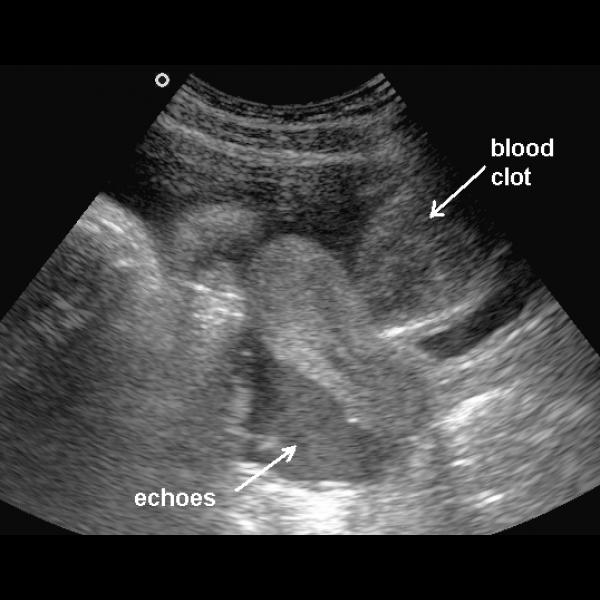 Massive Hemoperitoneum from a Ruptured Corpus Luteal Cyst